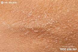 tính năng nổi bật da bị khô ngứa bong tróc
