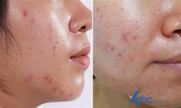 tính năng nổi bật da bóng dầu