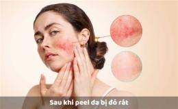 tính năng nổi bật da bong sau peel bị đỏ