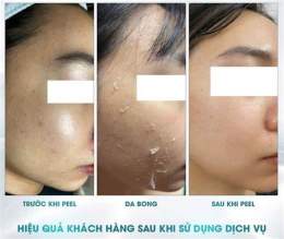 tính năng nổi bật da đang bong sau peel nên làm gì