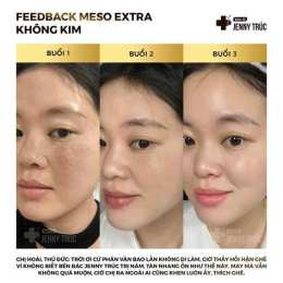 tính năng nổi bật meso căng bóng da