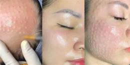 tính năng nổi bật tiêm căng bóng da mặt giá bao nhiêu