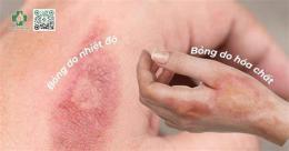 tính năng nổi bật vết bỏng lên da non