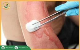 tính năng nổi bật xử lý vết bỏng bị tróc da