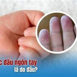 trẻ bị bong da đầu ngón tay