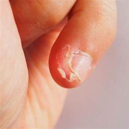 trẻ bị bong da tay chân là thiếu chất gì