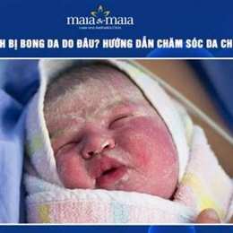 trẻ sơ sinh bị bong da