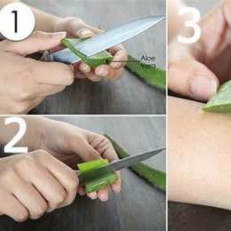 trị bỏng da bằng nha đam