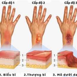vết bỏng lên da non