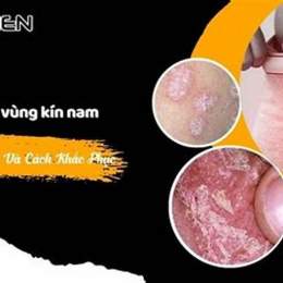 vùng kín bị khô bong da có sao không