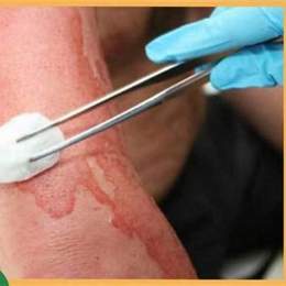 xử lý vết bỏng bị tróc da